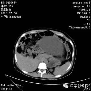 【病例】卵巢粘液性囊腺瘤1例CT影像表现