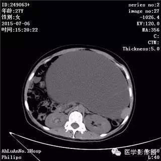 【病例】卵巢粘液性囊腺瘤1例CT影像表现 【病例】卵巢粘液性囊腺瘤1例CT影像表现
