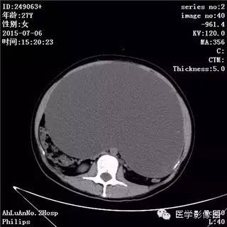 【病例】卵巢粘液性囊腺瘤1例CT影像表现 【病例】卵巢粘液性囊腺瘤1例CT影像表现