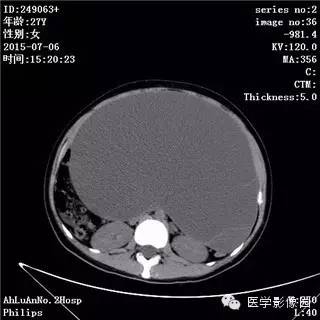 【病例】卵巢粘液性囊腺瘤1例CT影像表现 【病例】卵巢粘液性囊腺瘤1例CT影像表现