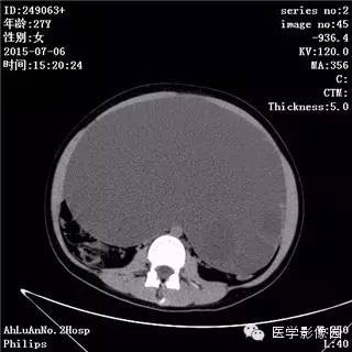 【病例】卵巢粘液性囊腺瘤1例CT影像表现 【病例】卵巢粘液性囊腺瘤1例CT影像表现