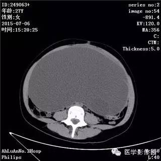 【病例】卵巢粘液性囊腺瘤1例CT影像表现 【病例】卵巢粘液性囊腺瘤1例CT影像表现