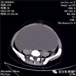 【病例】卵巢粘液性囊腺瘤1例CT影像表现 【病例】卵巢粘液性囊腺瘤1例CT影像表现