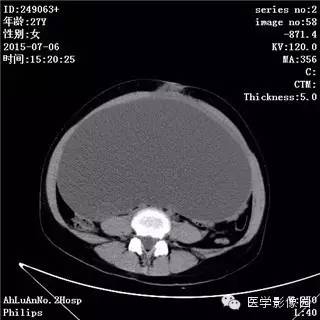 【病例】卵巢粘液性囊腺瘤1例CT影像表现 【病例】卵巢粘液性囊腺瘤1例CT影像表现