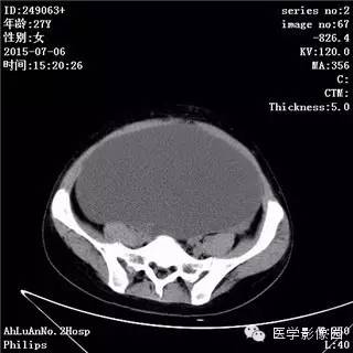 【病例】卵巢粘液性囊腺瘤1例CT影像表现 【病例】卵巢粘液性囊腺瘤1例CT影像表现