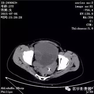 【病例】卵巢粘液性囊腺瘤1例CT影像表现 【病例】卵巢粘液性囊腺瘤1例CT影像表现