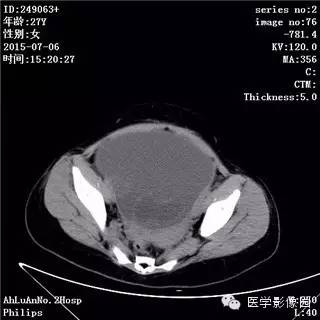 【病例】卵巢粘液性囊腺瘤1例CT影像表现 【病例】卵巢粘液性囊腺瘤1例CT影像表现