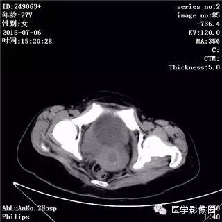【病例】卵巢粘液性囊腺瘤1例CT影像表现 【病例】卵巢粘液性囊腺瘤1例CT影像表现