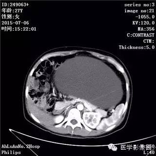 【病例】卵巢粘液性囊腺瘤1例CT影像表现 【病例】卵巢粘液性囊腺瘤1例CT影像表现