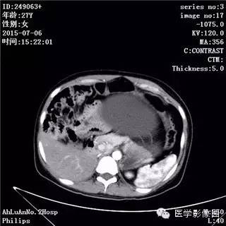 【病例】卵巢粘液性囊腺瘤1例CT影像表现 【病例】卵巢粘液性囊腺瘤1例CT影像表现