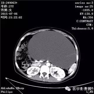 【病例】卵巢粘液性囊腺瘤1例CT影像表现 【病例】卵巢粘液性囊腺瘤1例CT影像表现