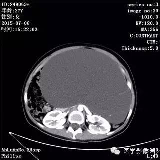 【病例】卵巢粘液性囊腺瘤1例CT影像表现 【病例】卵巢粘液性囊腺瘤1例CT影像表现