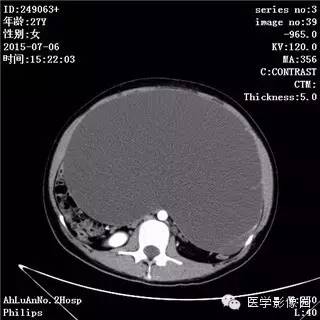 【病例】卵巢粘液性囊腺瘤1例CT影像表现 【病例】卵巢粘液性囊腺瘤1例CT影像表现
