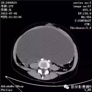 【病例】卵巢粘液性囊腺瘤1例CT影像表现 【病例】卵巢粘液性囊腺瘤1例CT影像表现