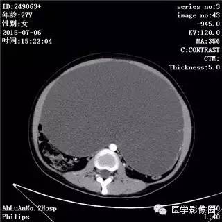 【病例】卵巢粘液性囊腺瘤1例CT影像表现 【病例】卵巢粘液性囊腺瘤1例CT影像表现