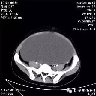 【病例】卵巢粘液性囊腺瘤1例CT影像表现 【病例】卵巢粘液性囊腺瘤1例CT影像表现