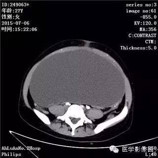 【病例】卵巢粘液性囊腺瘤1例CT影像表现 【病例】卵巢粘液性囊腺瘤1例CT影像表现