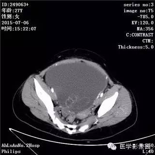 【病例】卵巢粘液性囊腺瘤1例CT影像表现 【病例】卵巢粘液性囊腺瘤1例CT影像表现
