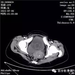 【病例】卵巢粘液性囊腺瘤1例CT影像表现 【病例】卵巢粘液性囊腺瘤1例CT影像表现