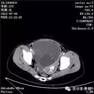 【病例】卵巢粘液性囊腺瘤1例CT影像表现 【病例】卵巢粘液性囊腺瘤1例CT影像表现