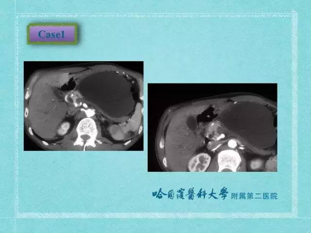 【病例】胰腺假性囊肿1例CT及MR影像表现