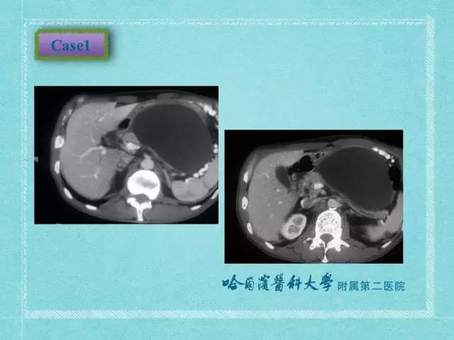 【病例】胰腺假性囊肿1例CT及MR影像表现