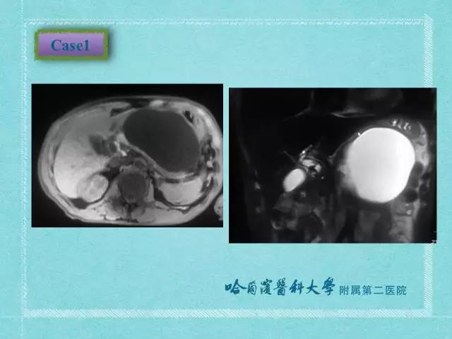 【病例】胰腺假性囊肿1例CT及MR影像表现