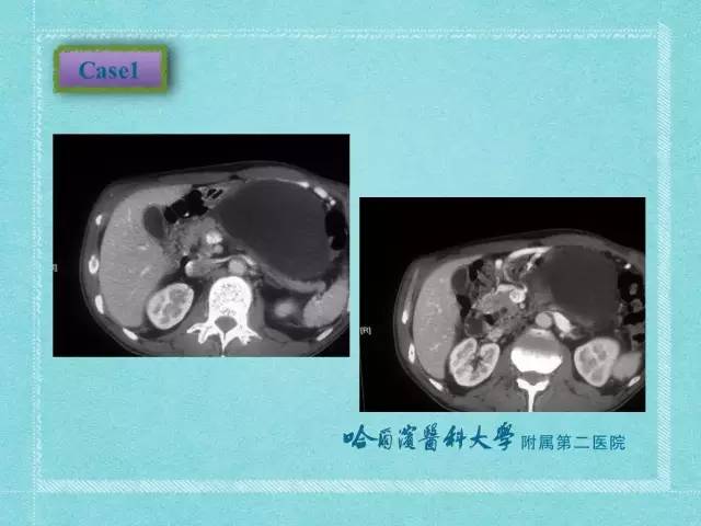 【病例】胰腺假性囊肿1例CT及MR影像表现