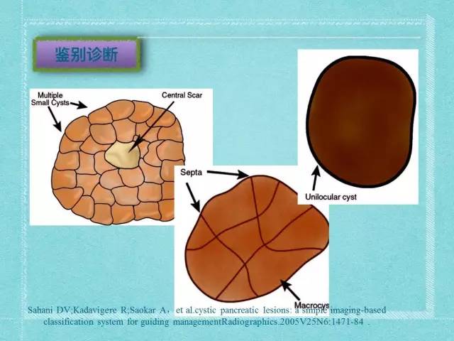 【病例】胰腺假性囊肿1例CT及MR影像表现