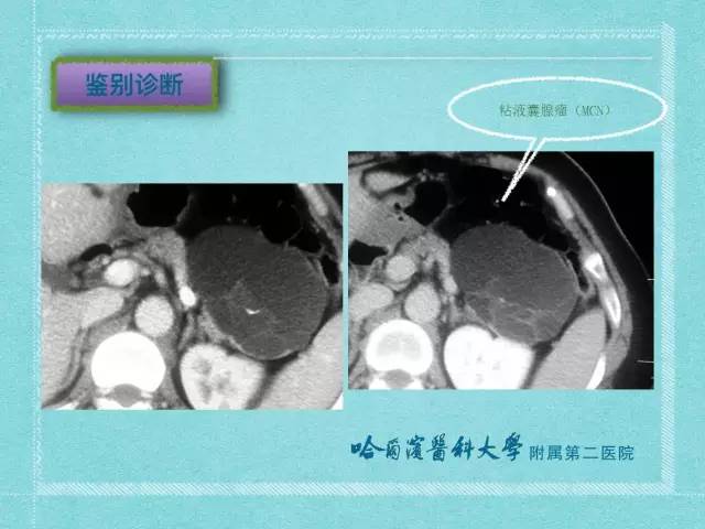 【病例】胰腺假性囊肿1例CT及MR影像表现
