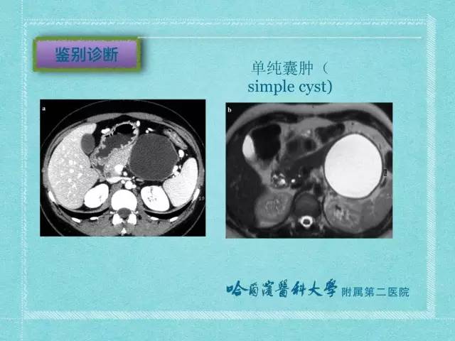 【病例】胰腺假性囊肿1例CT及MR影像表现