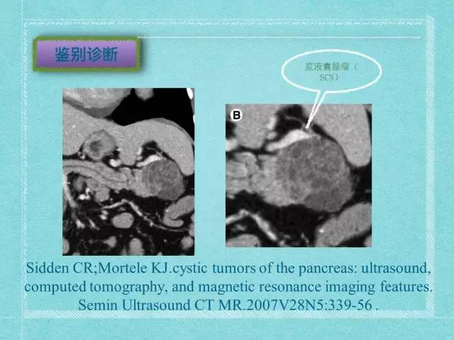 【病例】胰腺假性囊肿1例CT及MR影像表现