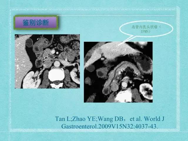 【病例】胰腺假性囊肿1例CT及MR影像表现