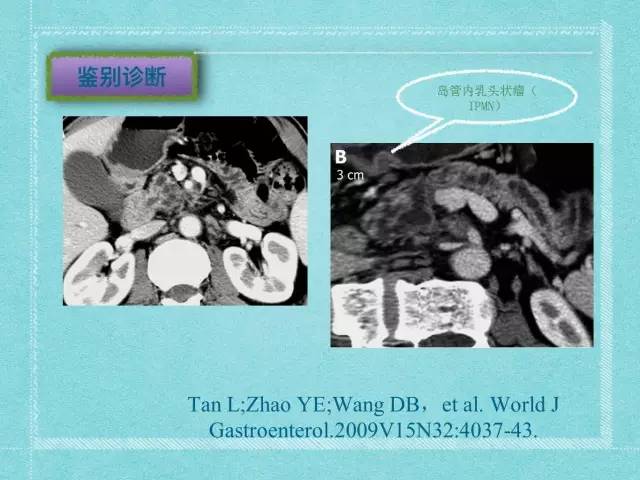 【病例】胰腺假性囊肿1例CT及MR影像表现