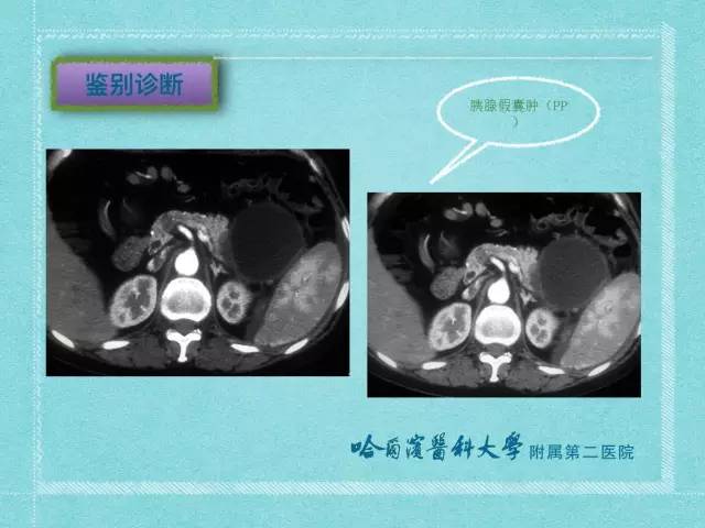 【病例】胰腺假性囊肿1例CT及MR影像表现