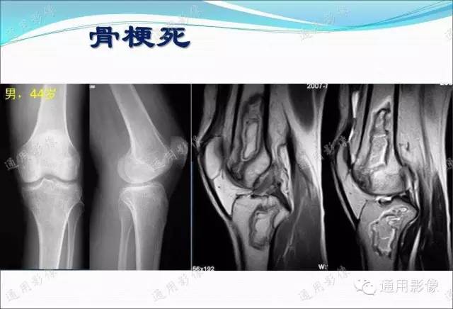 【PPT】骨关节序列临床应用