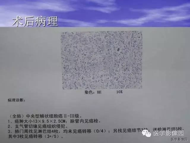 【病例】巨大中央型肺癌1例