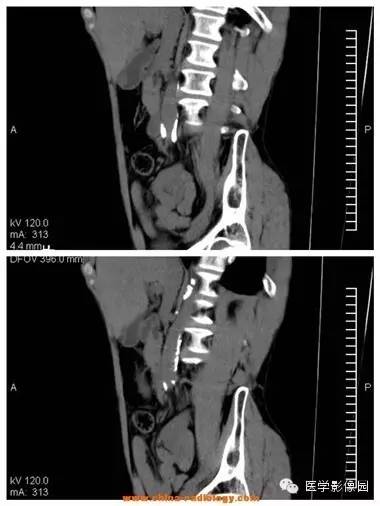 【病例】胆囊腺肌症1例CT影像表现 【病例】胆囊腺肌症1例CT影像表现