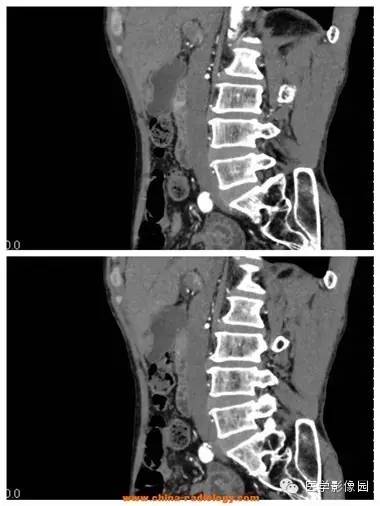 【病例】胆囊腺肌症1例CT影像表现 【病例】胆囊腺肌症1例CT影像表现
