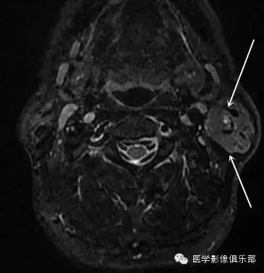 腮腺腺淋巴瘤的影像诊断 腮腺腺淋巴瘤的影像诊断