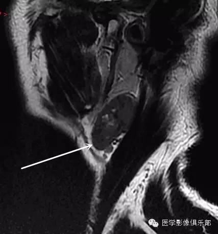 腮腺腺淋巴瘤的影像诊断 腮腺腺淋巴瘤的影像诊断
