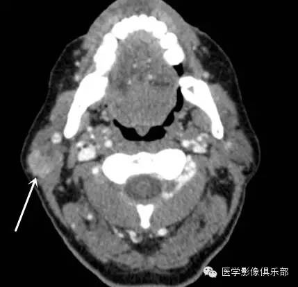 腮腺腺淋巴瘤的影像诊断 腮腺腺淋巴瘤的影像诊断