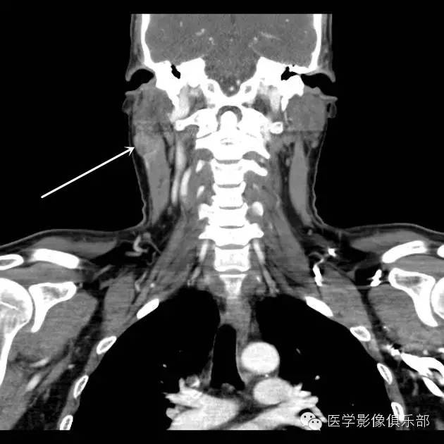腮腺腺淋巴瘤的影像诊断 腮腺腺淋巴瘤的影像诊断