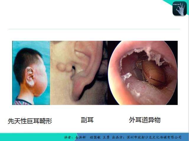【PPT】耳部疾病CT及MRI诊断