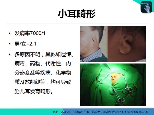 【PPT】耳部疾病CT及MRI诊断