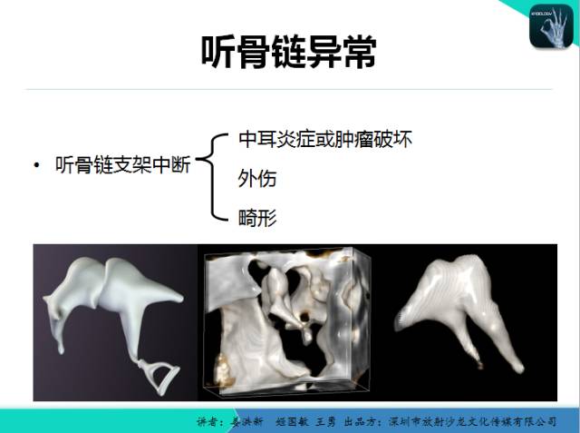 【PPT】耳部疾病CT及MRI诊断
