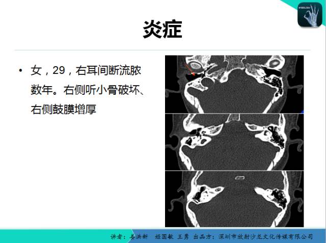 【PPT】耳部疾病CT及MRI诊断
