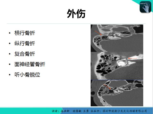 【PPT】耳部疾病CT及MRI诊断