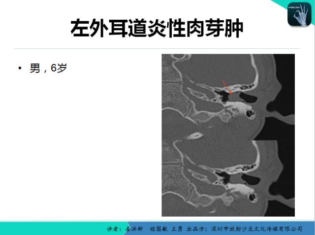 【PPT】耳部疾病CT及MRI诊断