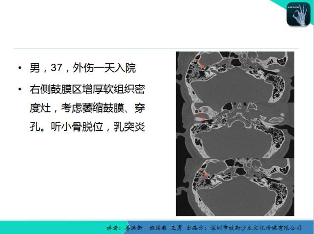 【PPT】耳部疾病CT及MRI诊断